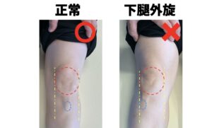 Ｏ脚 足首から曲がっている 原因 対処法