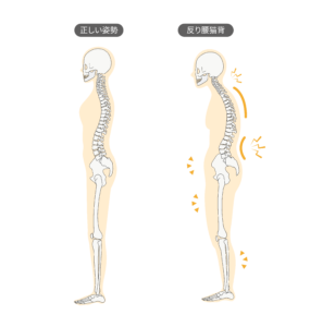 骨盤後傾 反り腰 原因 対処法