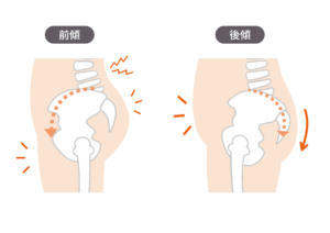 骨盤後傾 反り腰 原因 対処法