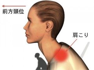 ストレートネック　前方頭位