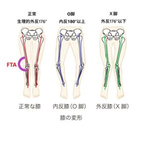 Ｏ脚 足首から曲がっている 原因 対処法