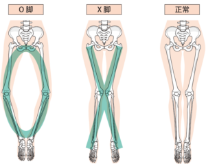 Ｏ脚 足首から曲がっている 原因 対処法