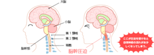 ストレートネック 治し方 脳幹