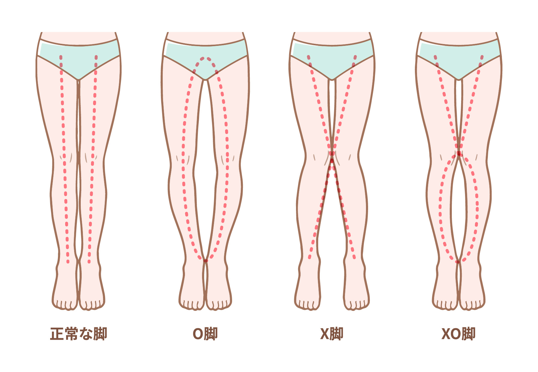 Ｏ脚・XO脚・X脚